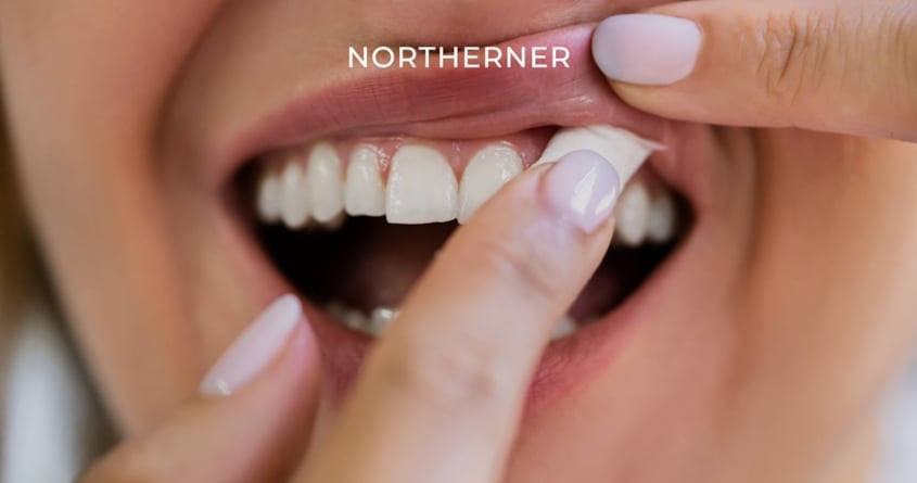 Ein Nikotinbeutel wird unter die Lippe platziert